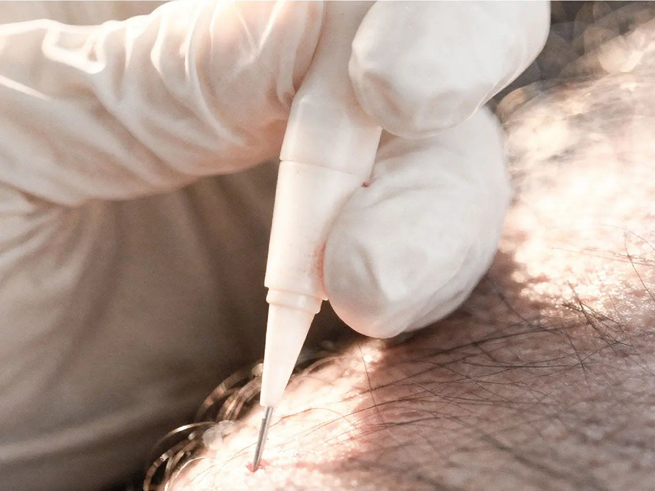 DHI Hair Transplant Technique