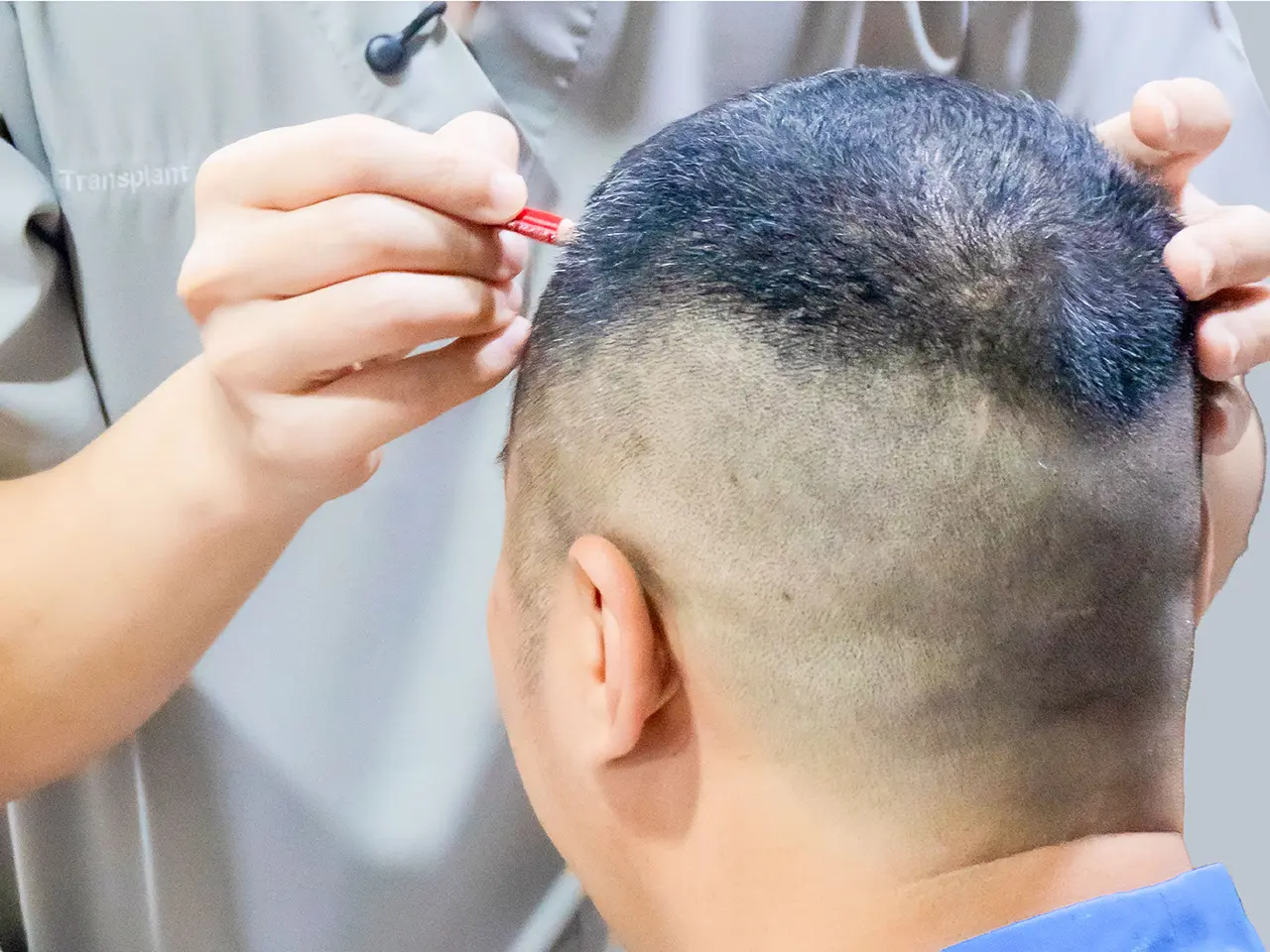 FUE Hair Transplant Technique