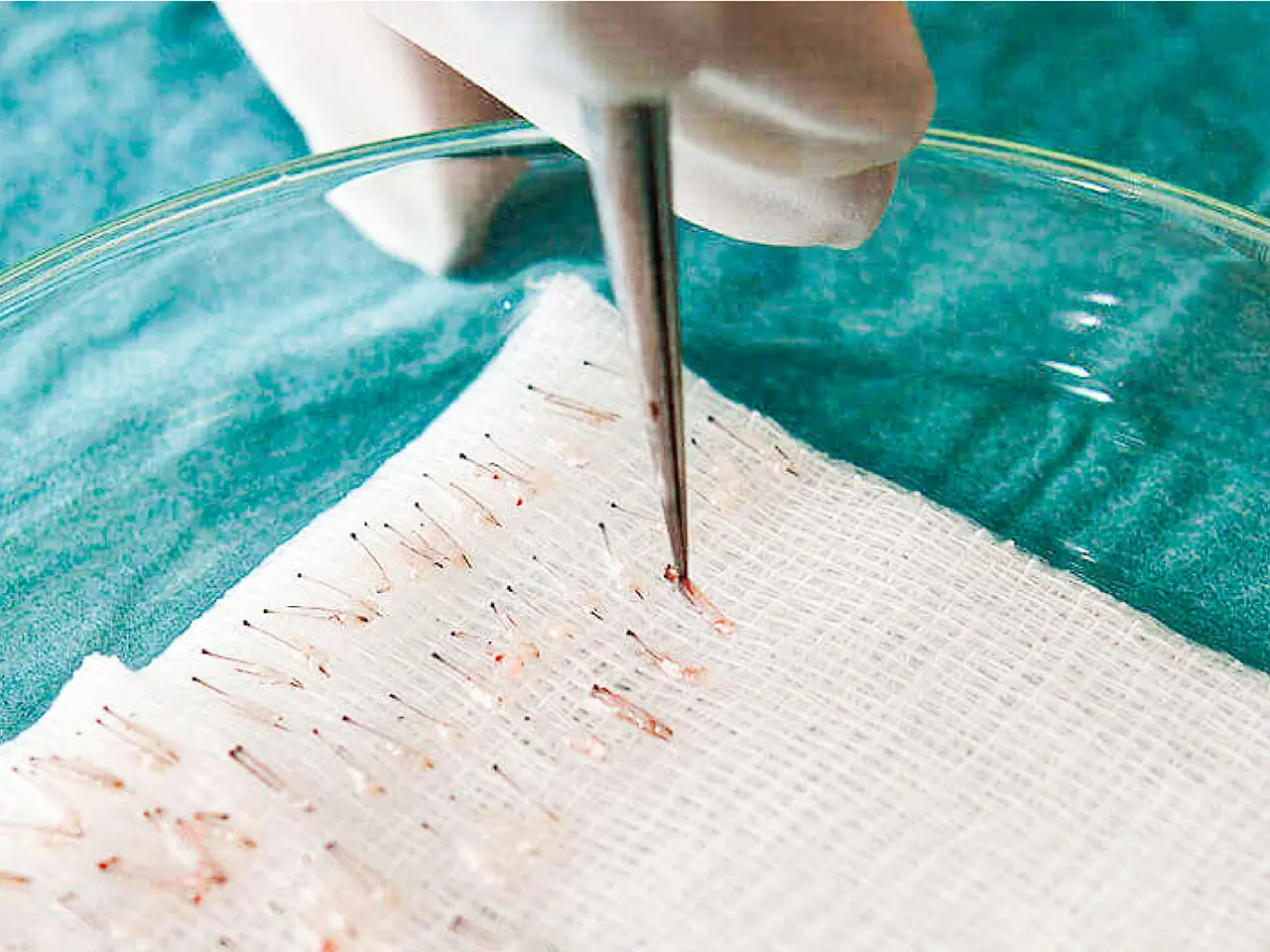 LEAN Hair Transplant Technique
