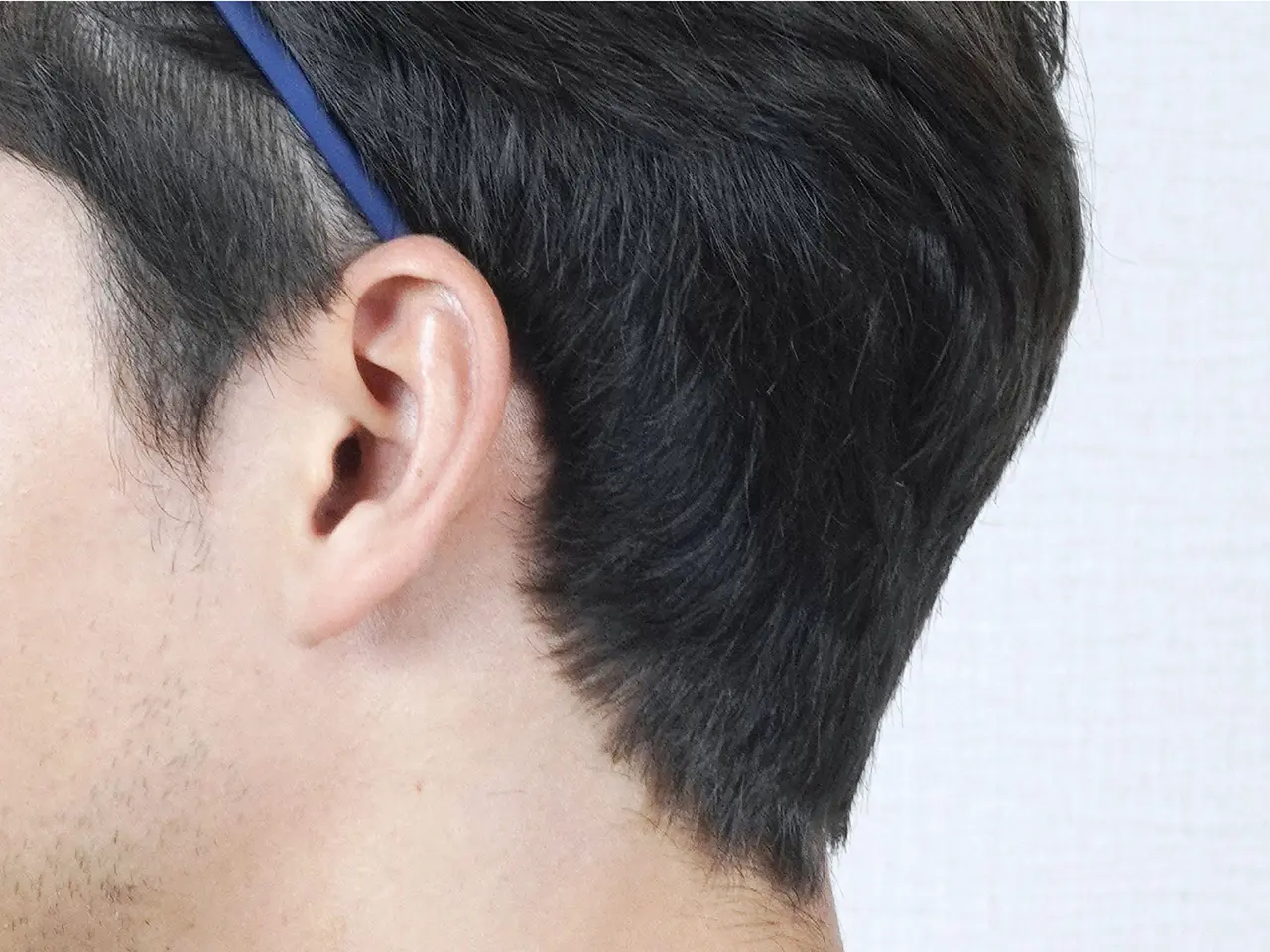 LEAN Non-Shaven Hair Transplant Technique
