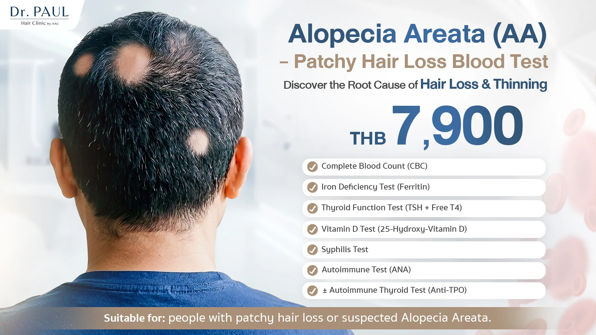 Blood test for patchy hair loss or alopecia areata.