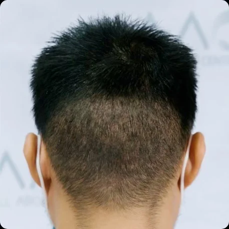 Donor area, 14 days after hair transplant.