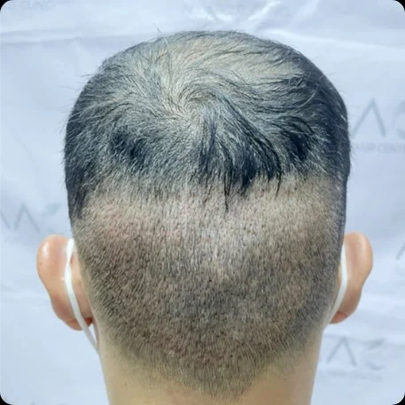 Donor area, one day after hair transplant.
