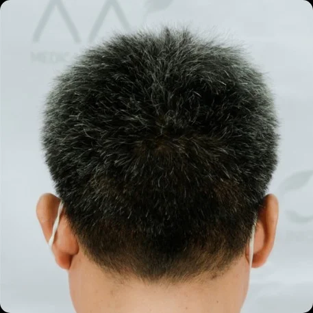 Donor area, one month (30 days) after hair transplant.