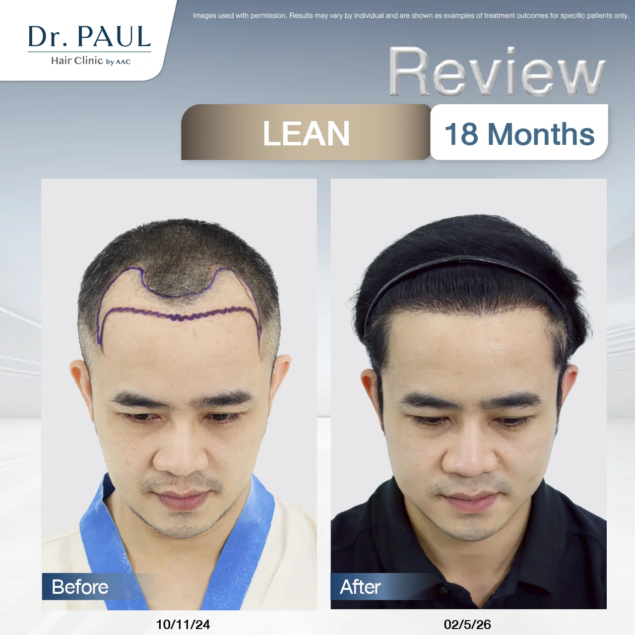 A male hair transplant review after 1 year and 6 months using the LEAN technique: results shown before and after.
