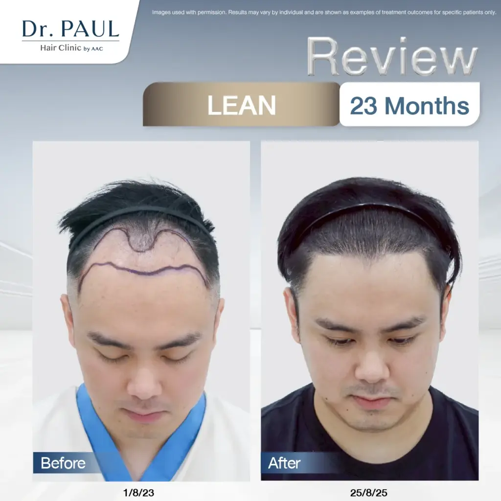 A male hair transplant review at 2 years using the LEAN technique: results shown before and after.