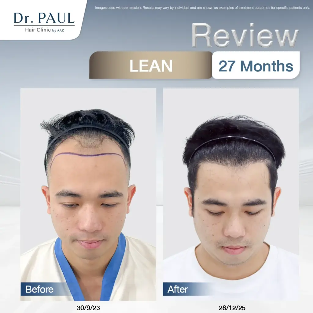 A male hair transplant review at 2 years and 3 months using the LEAN technique: results shown before and after.