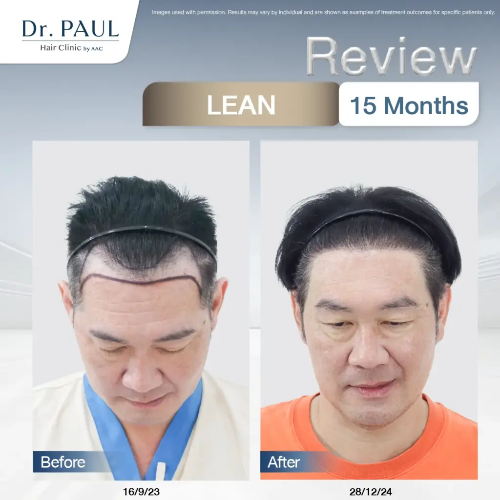 A man's 15-month hair transplant review using the LEAN technique: results shown before and after.