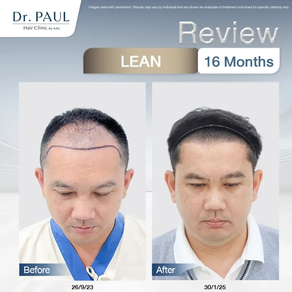 A man's 16-month hair transplant review using the LEAN technique: results shown before and after.