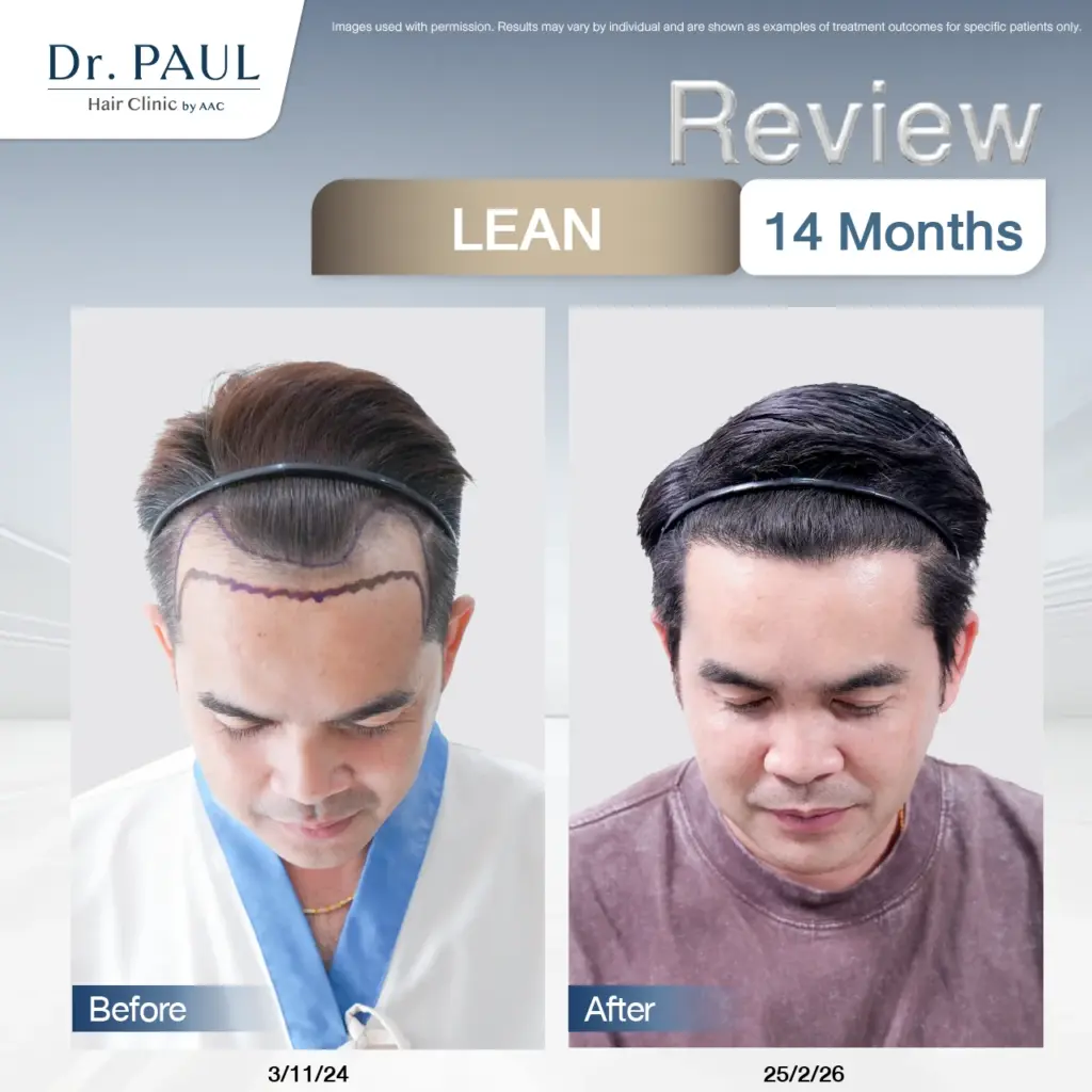 A 14-month review of male hair transplant results with the LEAN technique, shown before and after.
