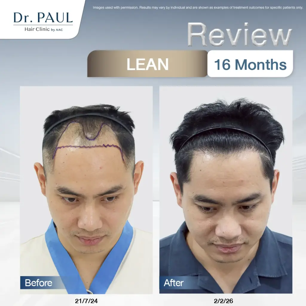 A 16-month review of male hair transplant results using the LEAN technique: before-and-after comparison.