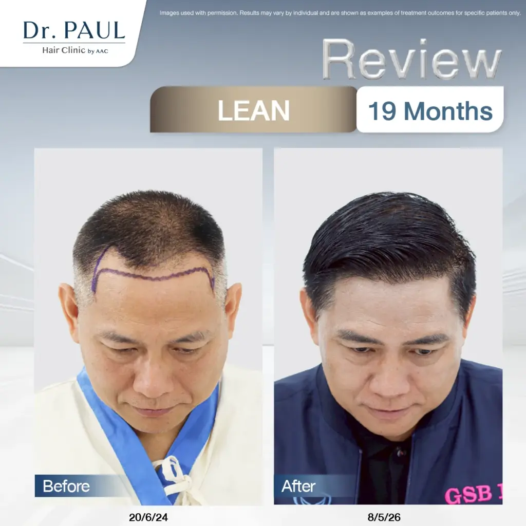 Reviewing male hair transplant results at 19 months with the LEAN technique: before-and-after comparison.
