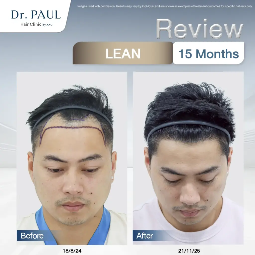 Male hair transplant review: before-and-after results after 15 months.