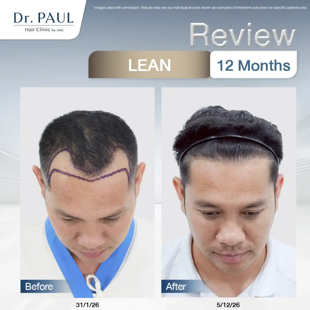 A male hair transplant review at 1 year: results shown before and after.