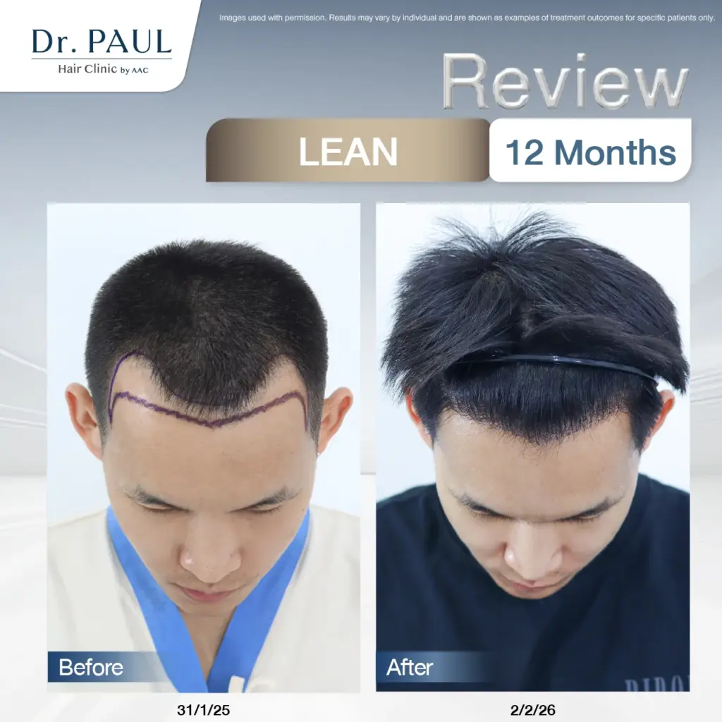 Male hair transplant results after 12 months (1 year) using the LEAN technique: before-and-after comparison.