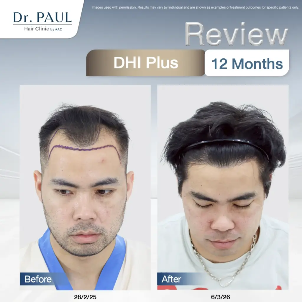 A male hair transplant review at 1 year using the DHI Plus technique: results shown before and after.