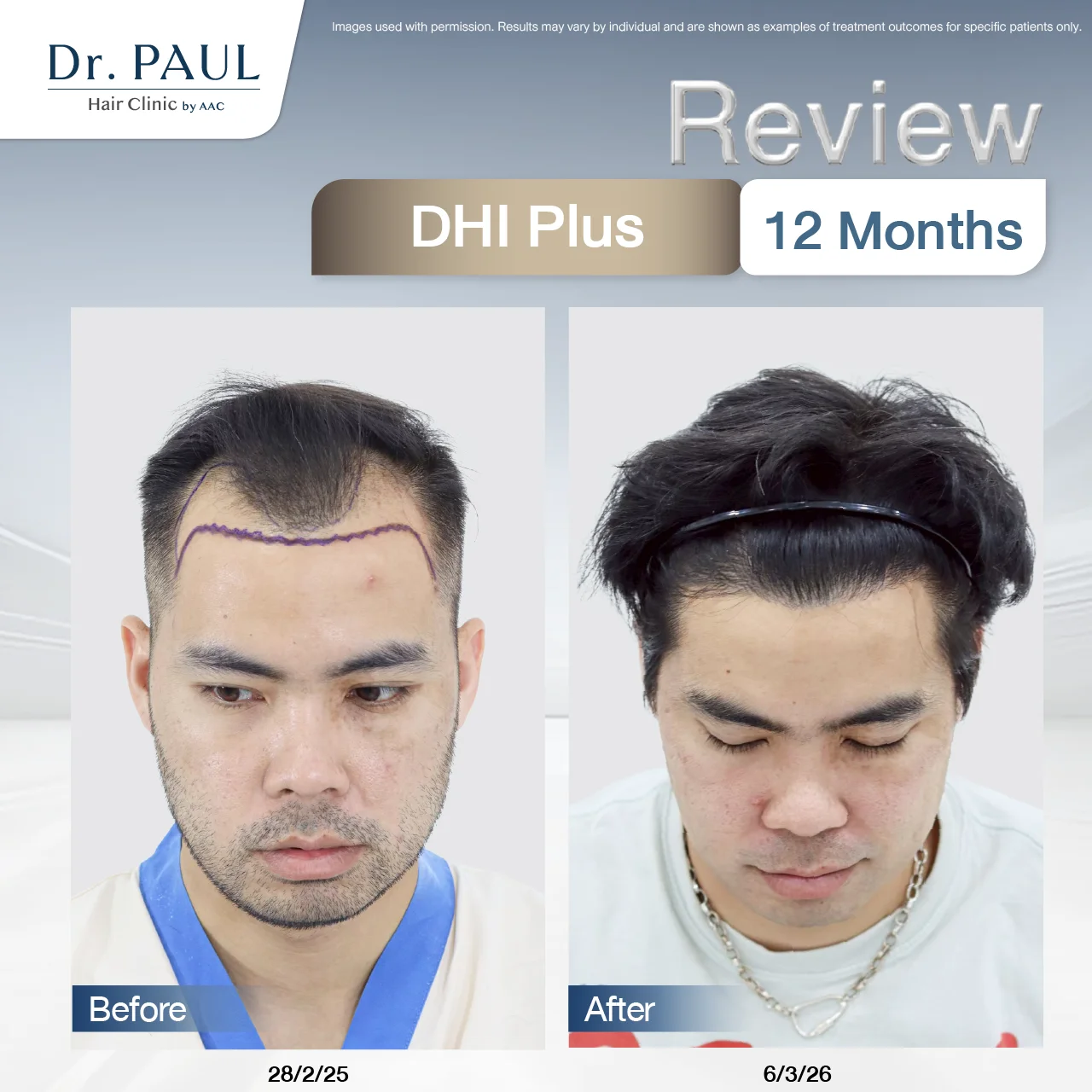 A male hair transplant review at 1 year using the DHI Plus technique: results shown before and after.