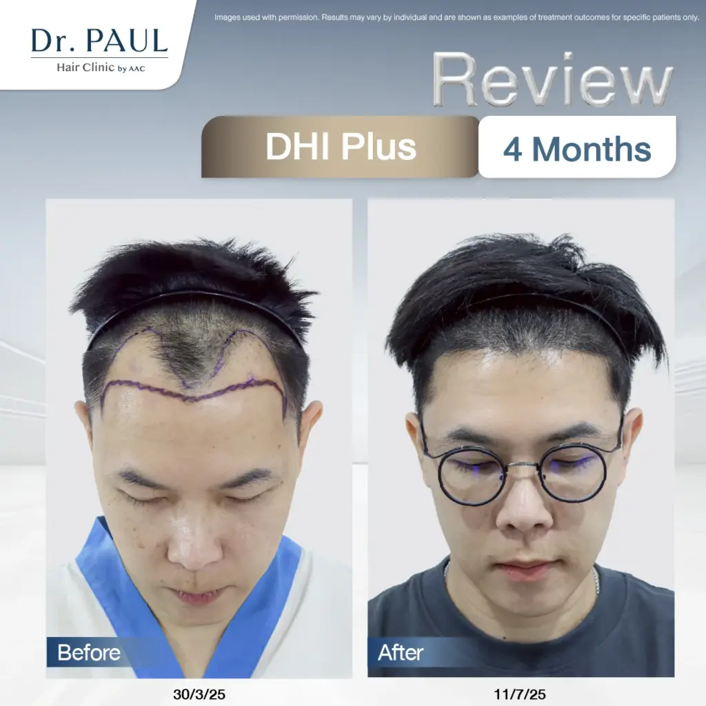 A male hair transplant review at 4 months using the DHI Plus technique: results shown before and after.