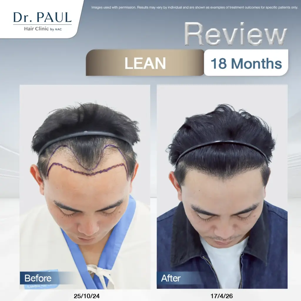 A male hair transplant review at 1 year and 6 months using the LEAN technique: results shown before and after.