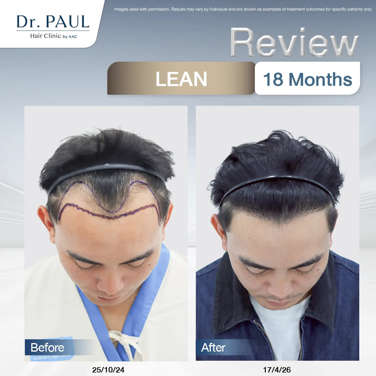 A male hair transplant review at 1 year and 6 months using the LEAN technique: results shown before and after.
