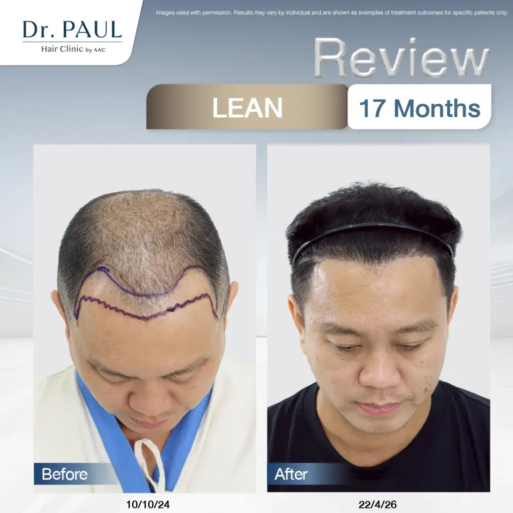 A male hair transplant review at 17 months using the LEAN technique: results shown before and after.