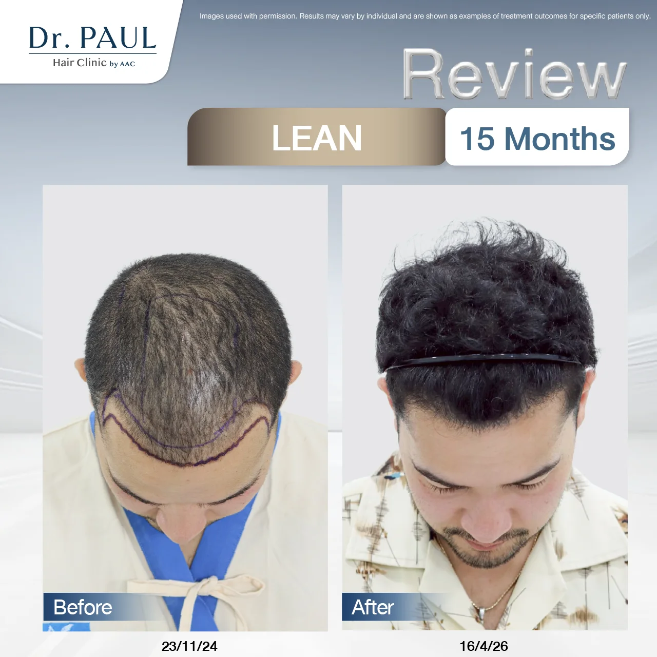 A male hair transplant review at 15 months using the LEAN technique: results shown before and after.