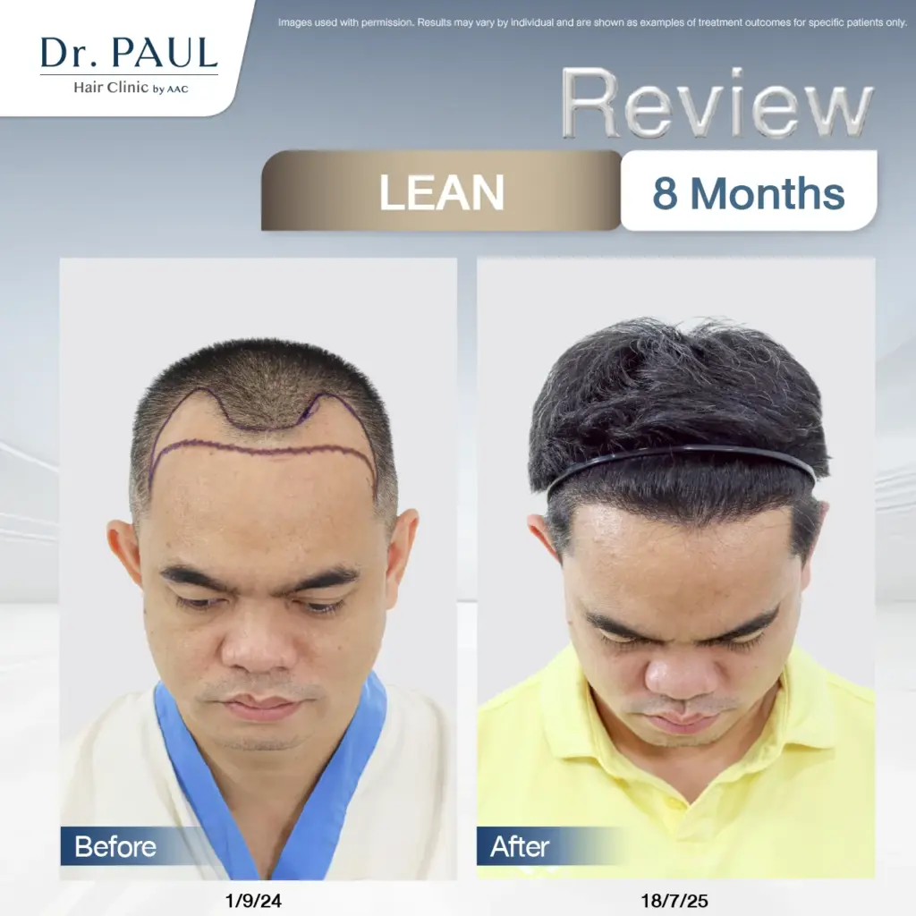 A male hair transplant review at 8 months using the LEAN technique: results shown before and after.