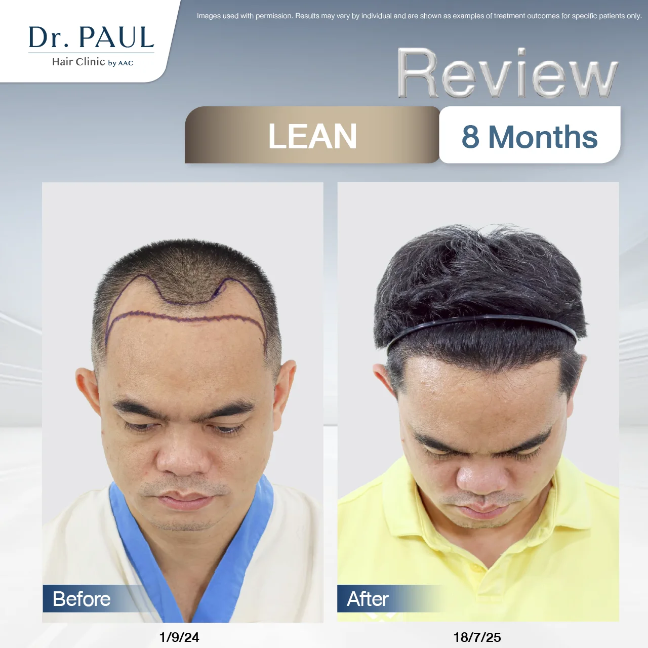 A male hair transplant review at 8 months using the LEAN technique: results shown before and after.
