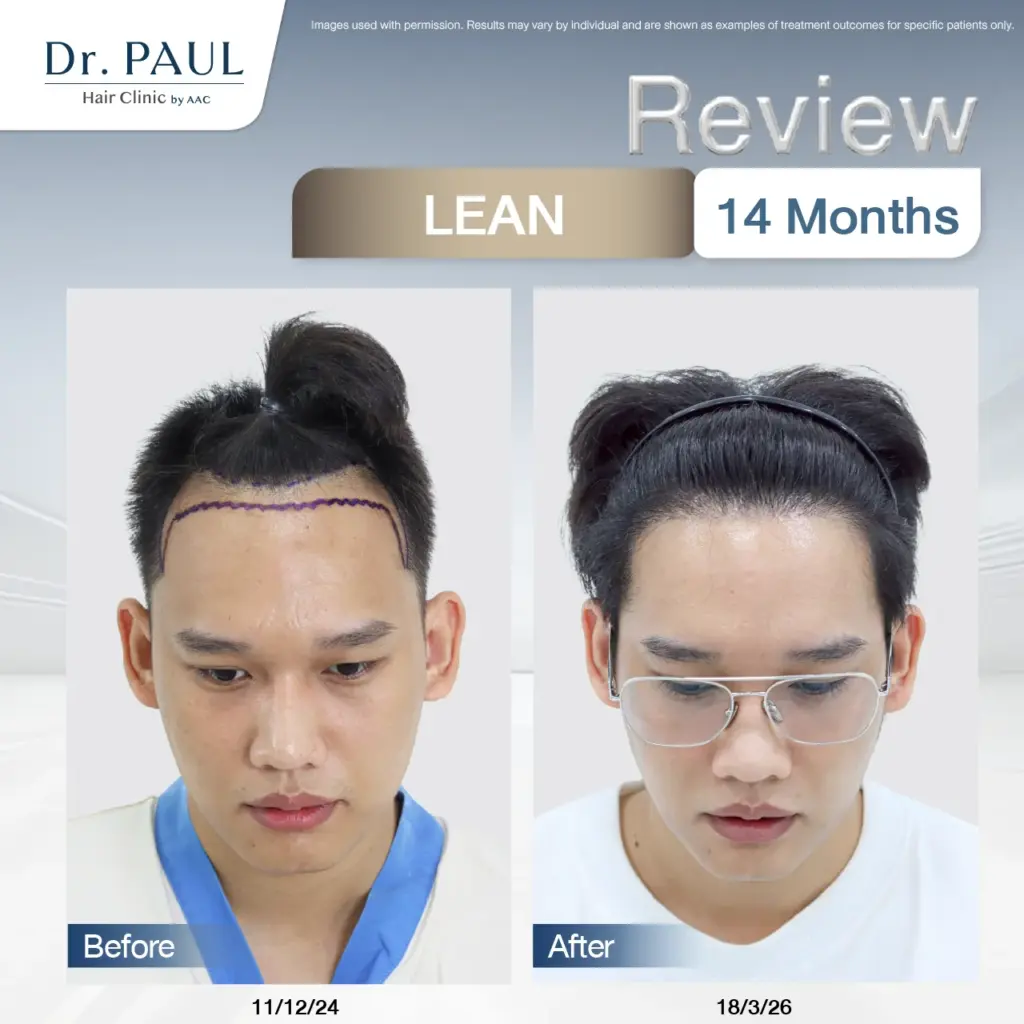 A male hair transplant review at 14 months using the LEAN technique: results shown before and after.
