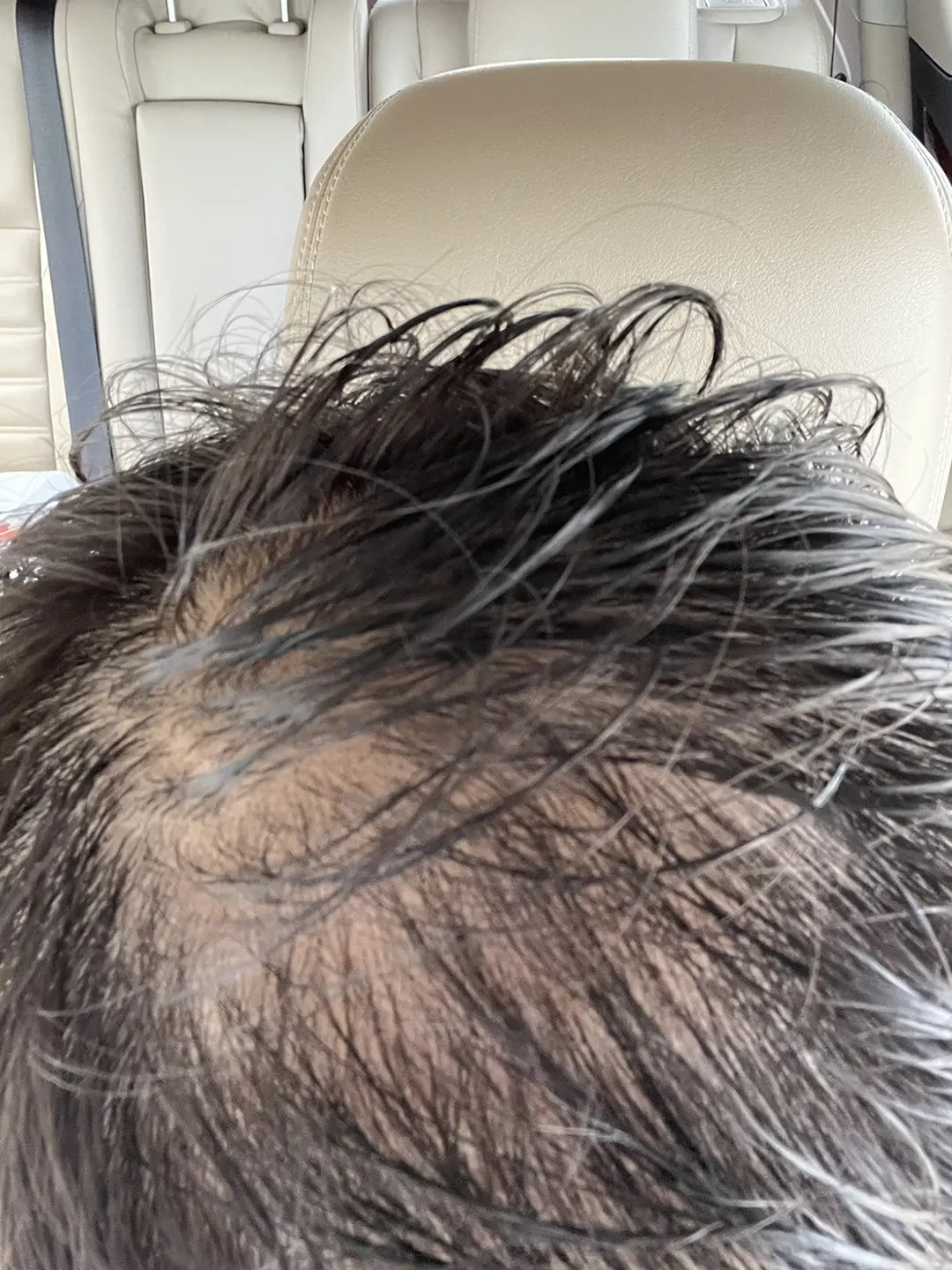 Dr. Paul understands hair loss firsthand.