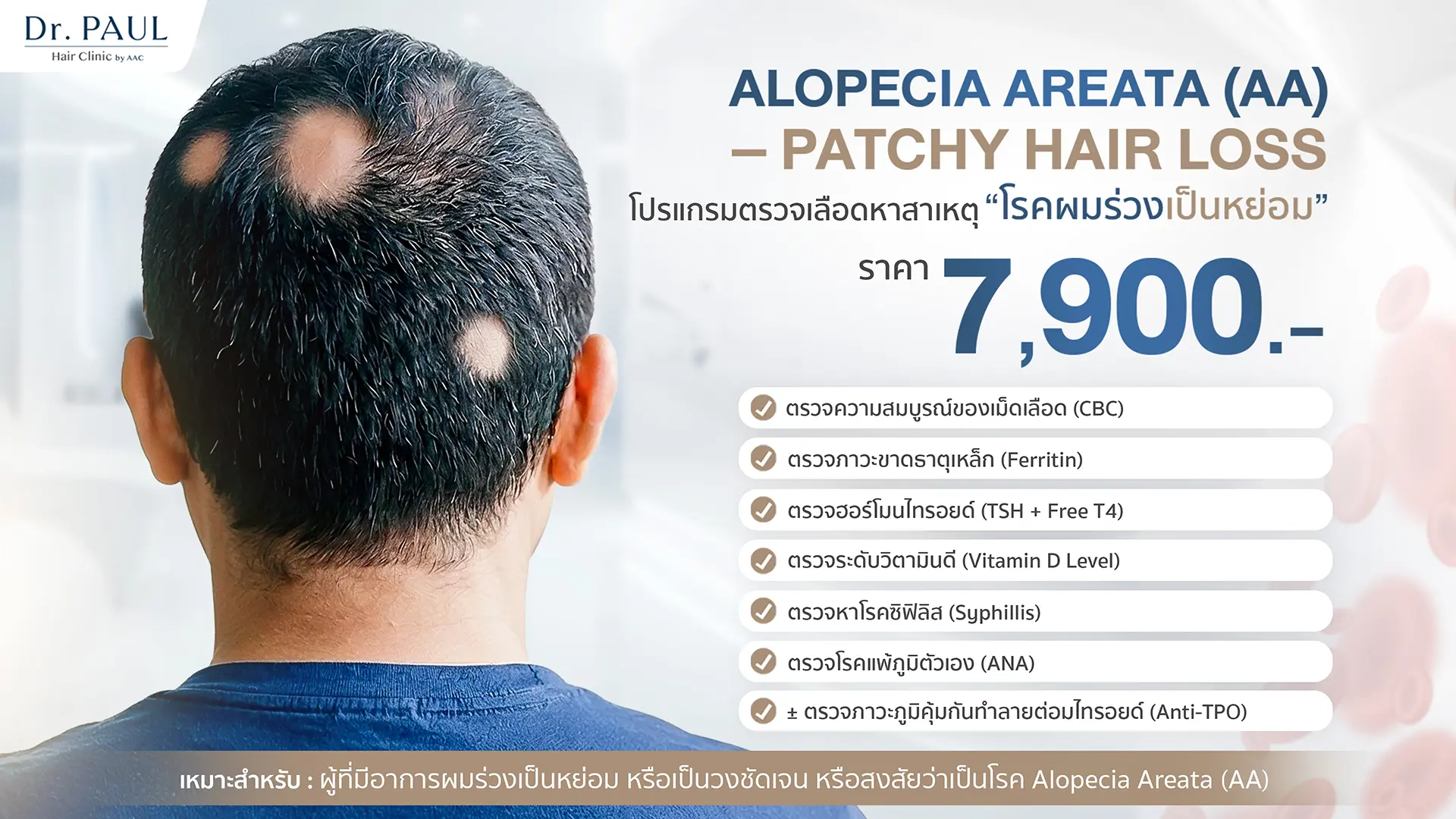 โปรแกรมตรวจเลือดหาสาเหตุผมร่วง สำหรับผู้ที่มีผมร่วงเป็นหย่อม (Alopecia Areata)
