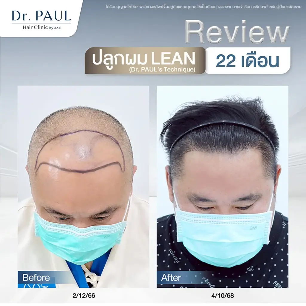 รีวิวปลูกผม 22 เดือน กรอบหน้าสวยชัดขึ้นมาก