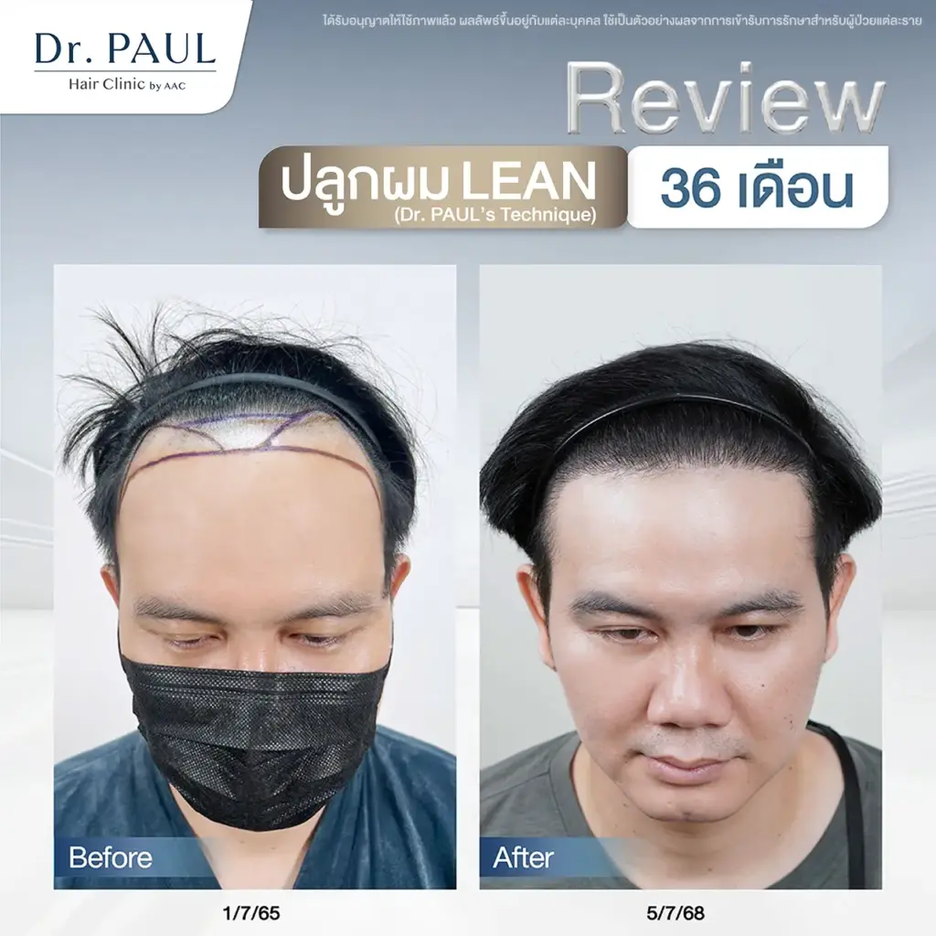 ปลูกผมมาแล้ว 3 ปี รีวิวรูปผลลัพธ์ เคสผู้ชาย
