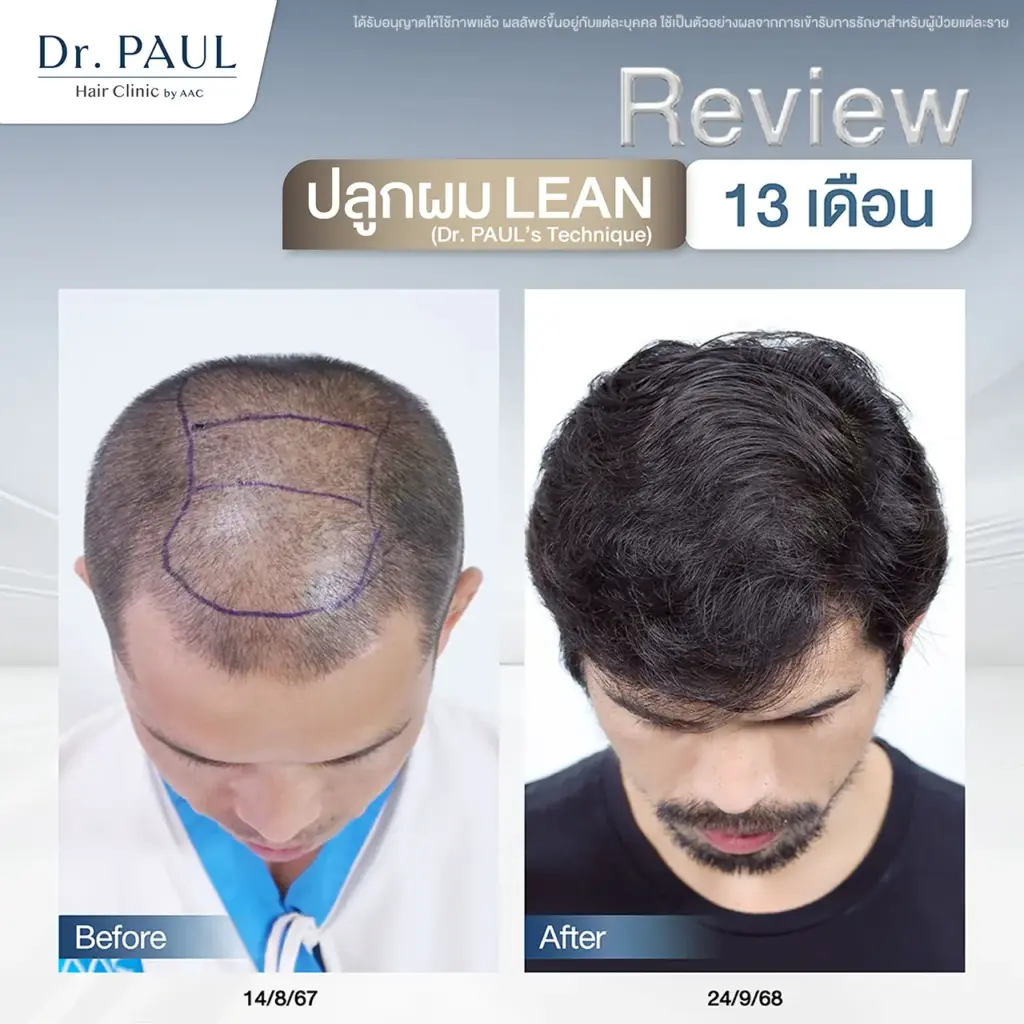รีวิวเปรียบเทียบก่อน-หลังปลูกผม 13 เดือนในผู้ชาย