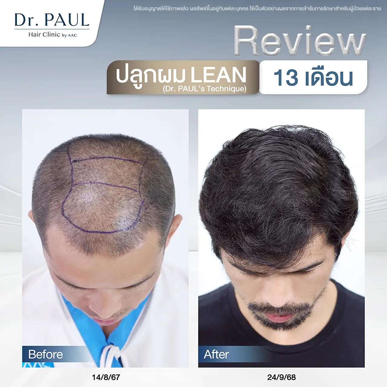 รีวิวเปรียบเทียบก่อน-หลังปลูกผม 13 เดือนในผู้ชาย