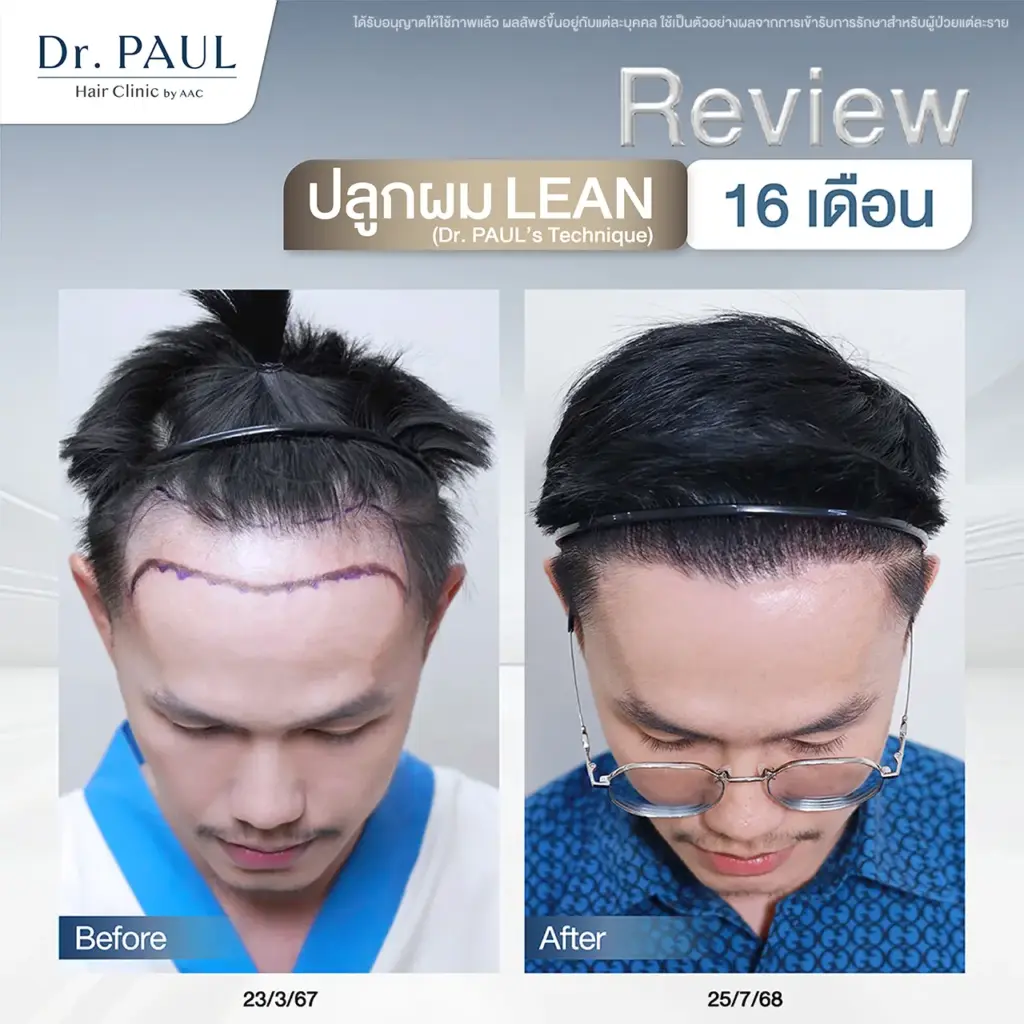 หลังปลูกผม 16 เดือนเป็นยังไง มาดูรูปรีวิวกัน