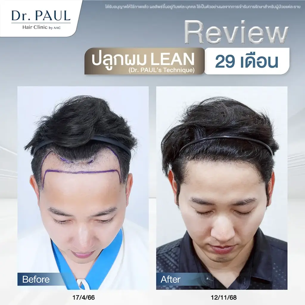 หลังปลูกผม 29 เดือน (2 ปี 5 เดือน) รีวิวผลลัพธ์แบบชัดๆ