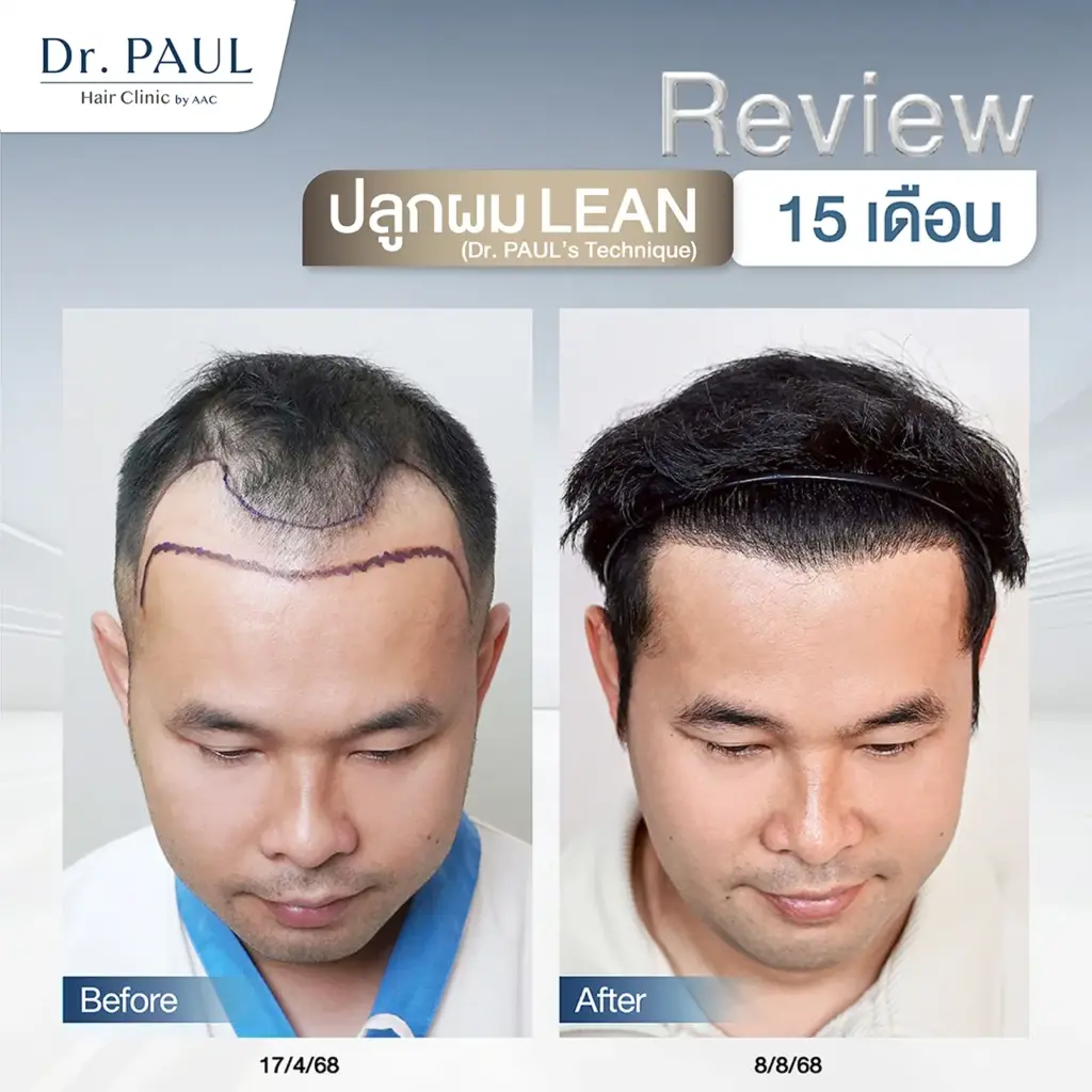 รีวิวผลลัพธ์หลังปลูกผมที่ 15 เดือนในผู้ชาย