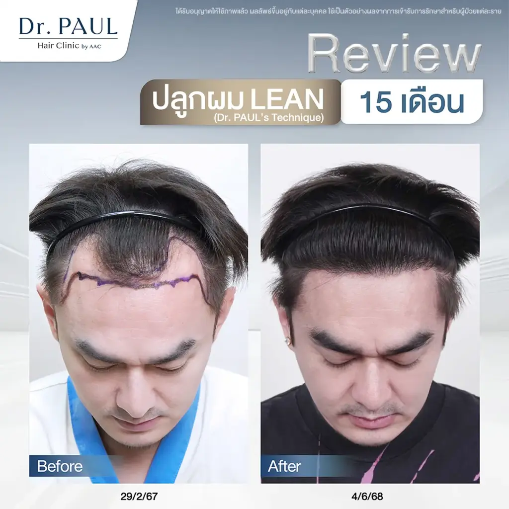 รีวิวปลูกผมแก้ผมเว้าลึก หลังปลูก 15 เดือนกลับมาดูอ่อนวัยและสดใสมากขึ้น