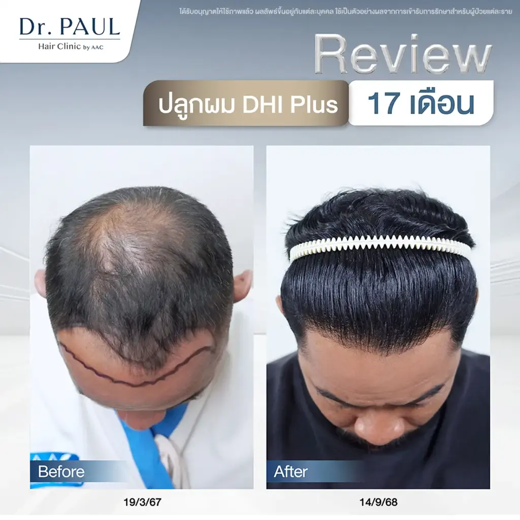 รีวิวปลูกผมผู้ชาย 17 เดือน ผมเต็มสวยเป็นธรรมชาติ