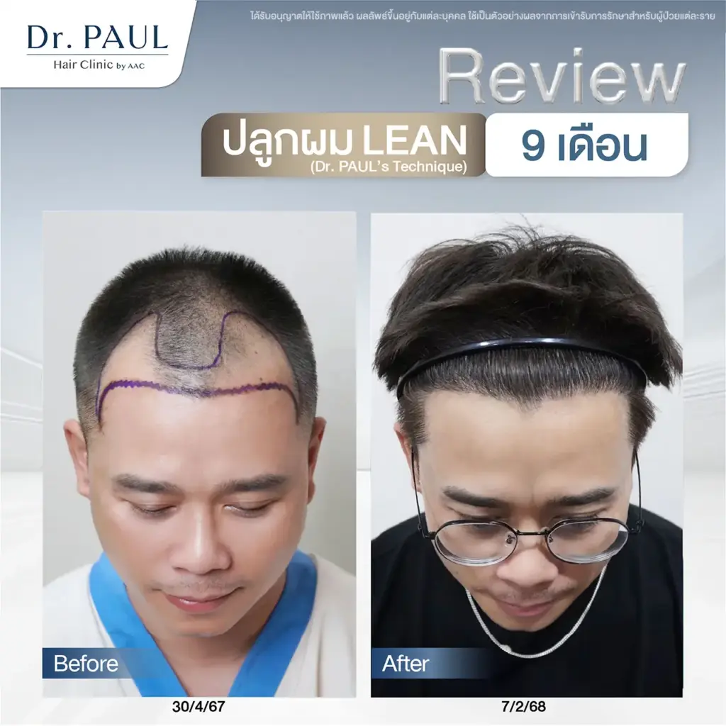 รีวิวหลังปลูกผมในผู้ชายที่ 9 เดือน