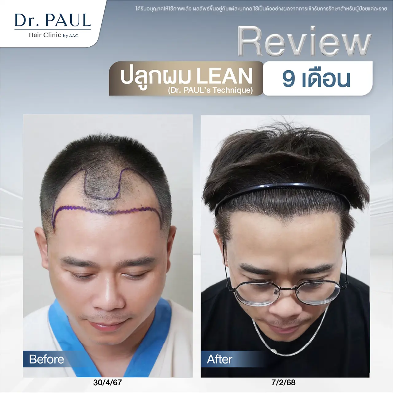 รีวิวหลังปลูกผมในผู้ชายที่ 9 เดือน