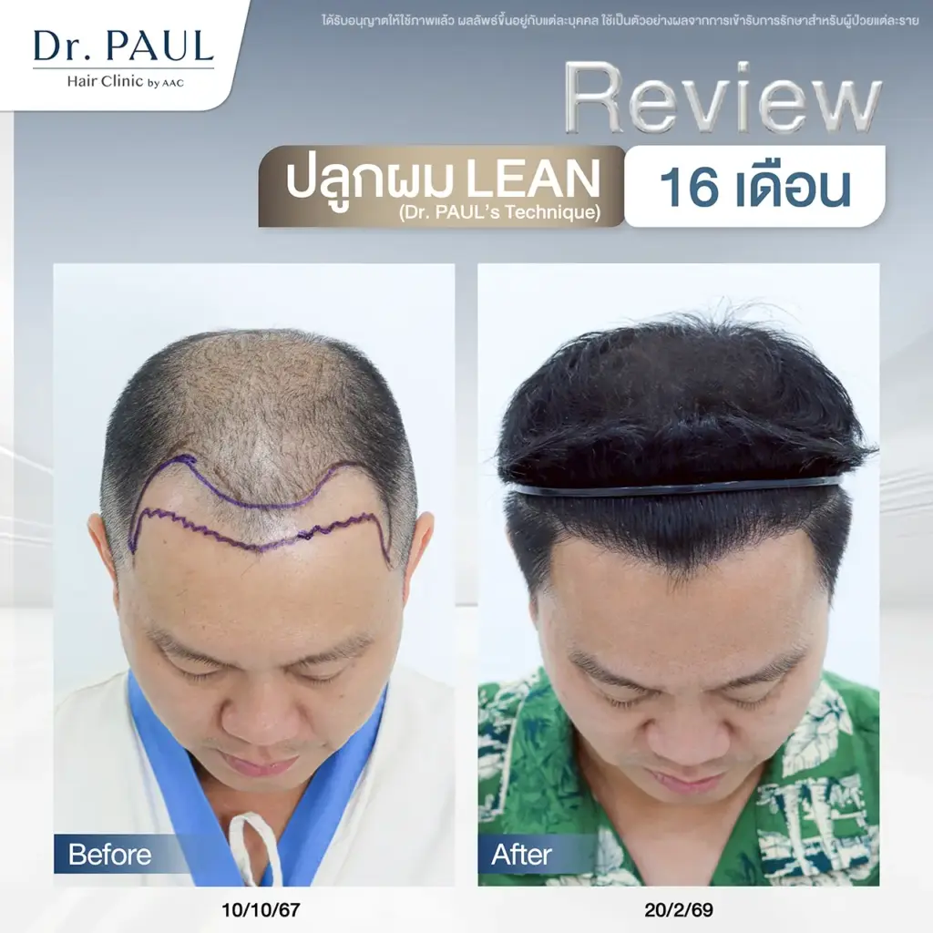 ปลูกผมดีไหม รีวิวผลลัพธ์ที่ 16 เดือน