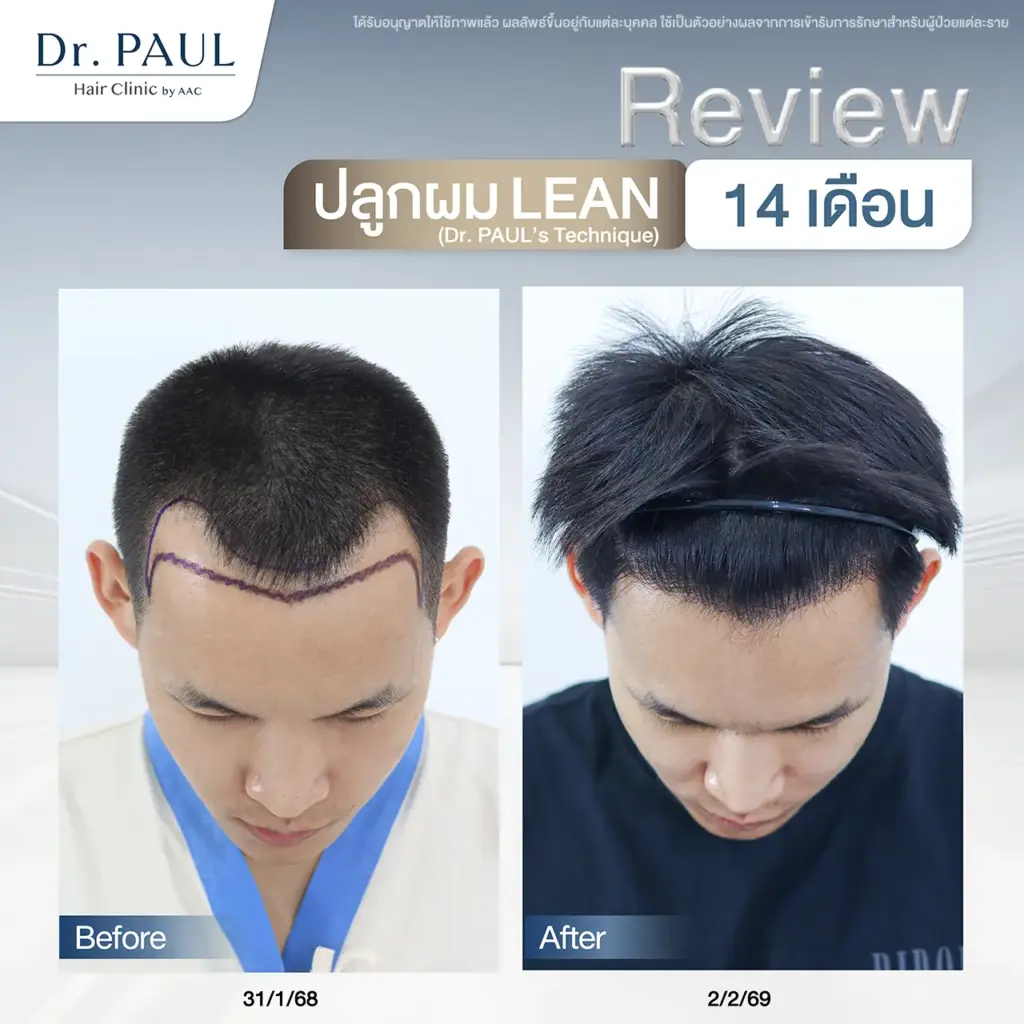 รีวิวหลังปลูกผม 14 เดือน ลุคดูสดใสสมวัยมากขึ้น