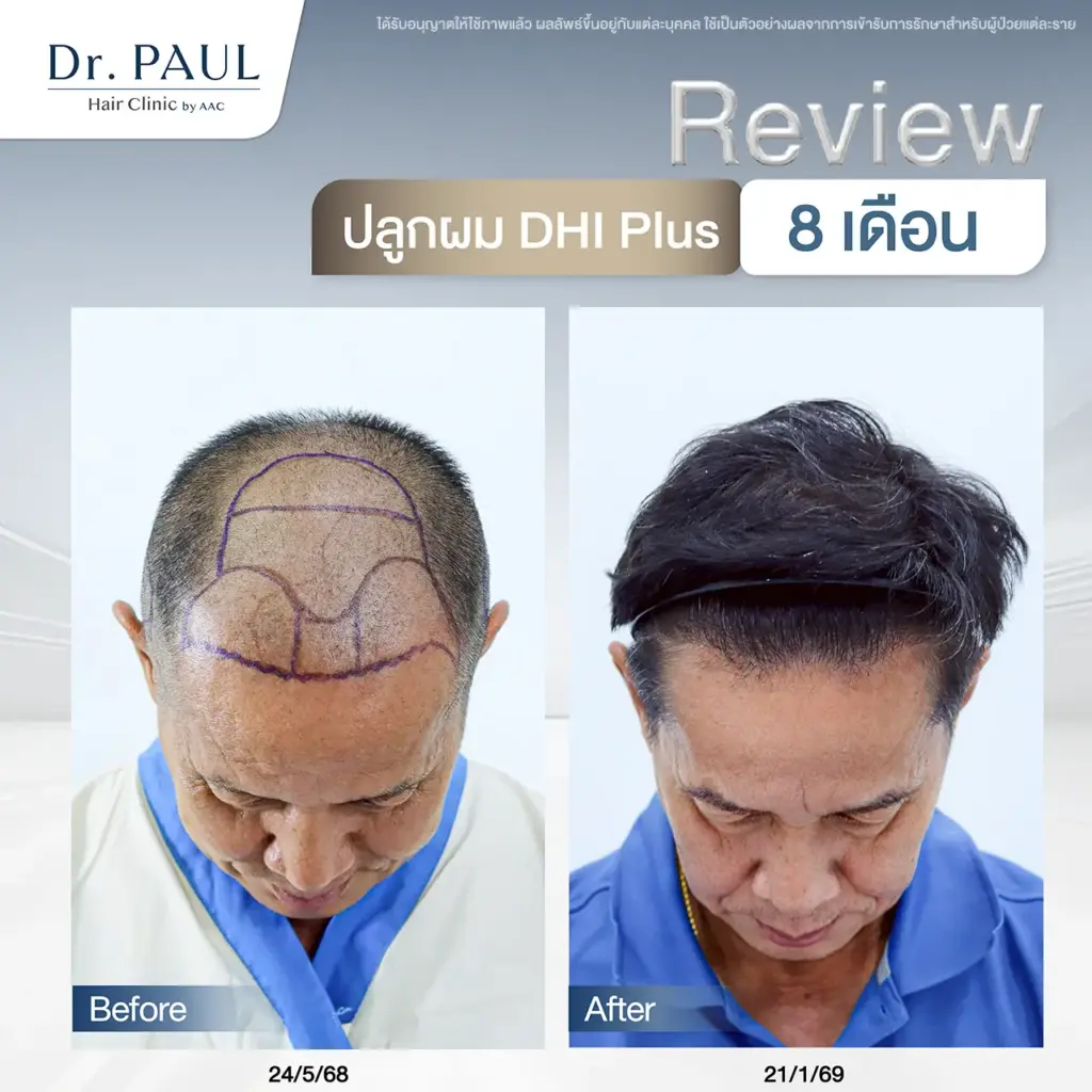 รีวิวผลลัพธ์จากการปลูกผม อายุเยอะก็ปลูกได้