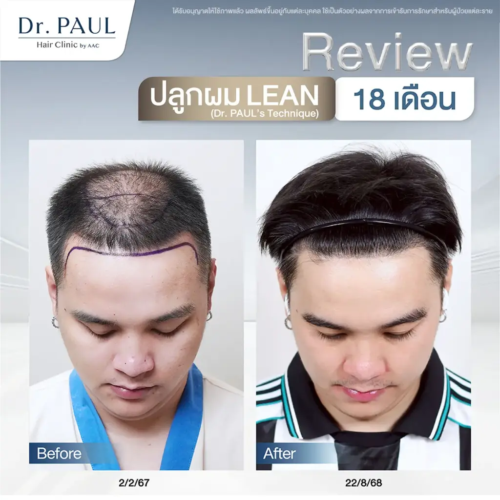 รีวิว หลังปลูกผม 18 เดือน แนวผมที่ถอยร่นกลับมาเต็มสวยอีกครั้ง