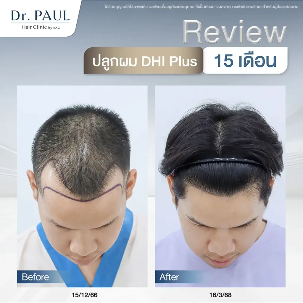 รีวิวปลูกผมผู้ชาย เปลี่ยนผมเว้าลึกให้ดกหนา