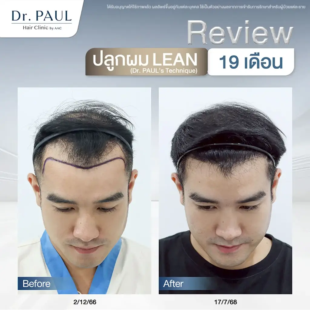 รีวิวปลูกผมแก้ผมเว้าเป็นรูปตัว M
