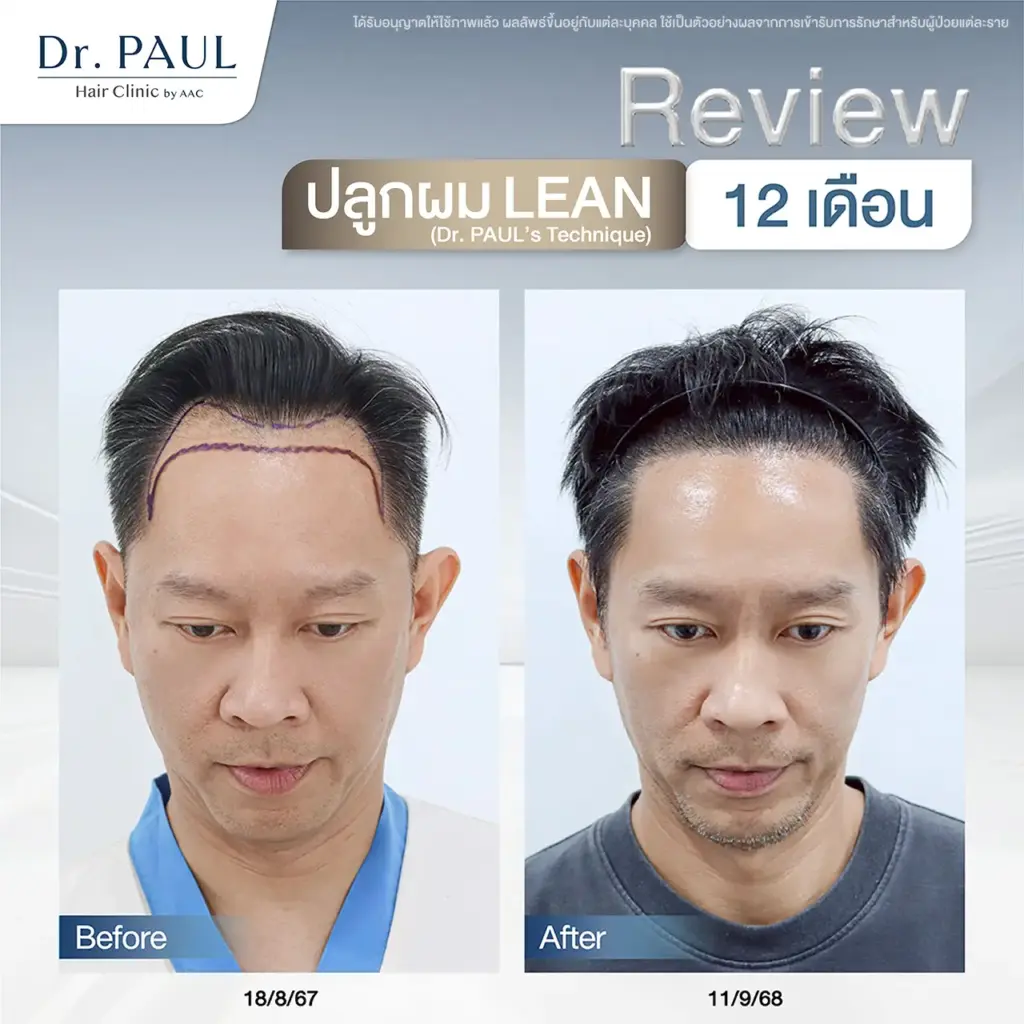 ปลูกผมเทคนิค LEAN รีวิวผลลัพธ์หลังผ่านไป 12 เดือน (1 ปี)