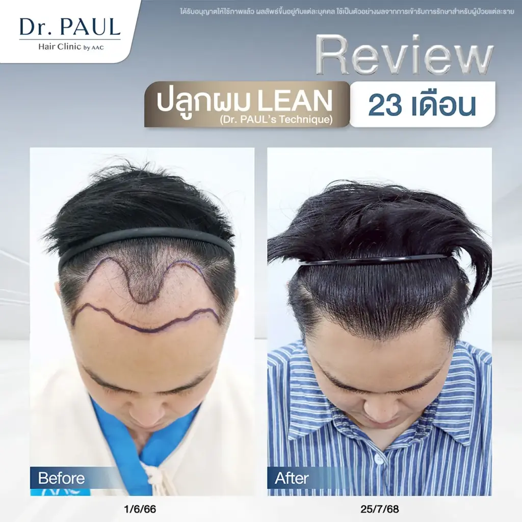 รีวิวผลลัพธ์ 23 เดือนหลังปลูกผม ที่ Dr. PAUL Hair Clinic